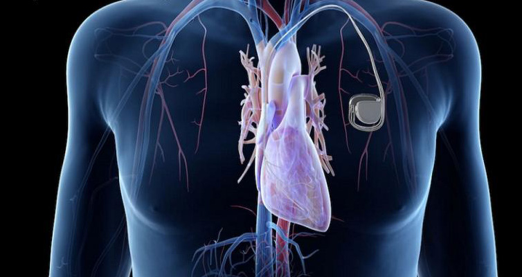 Implantable Loop Recorder Test Cardiology Tests SA Heart